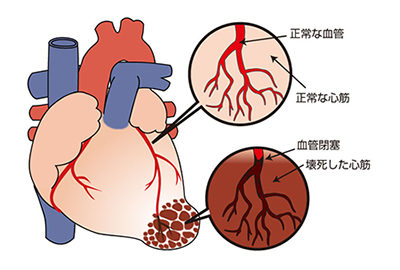 血管が詰まって心筋が壊死している図