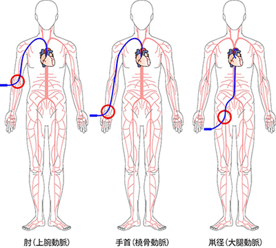 CAGに使うカテーテルの写真