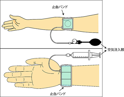 バンドで圧定している写真