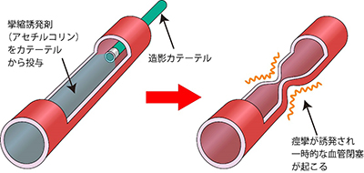 アセチルコリン負荷前後のCAG